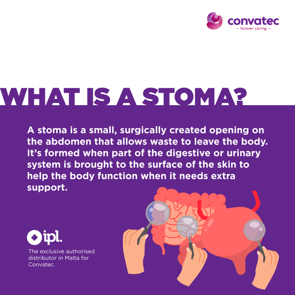 Stoma Inverting What is a stoma? - Ian Pace Ltd